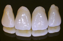 Porcelain dental crowns are artificial teeth that are carefully shaped and colored to match your natural teeth