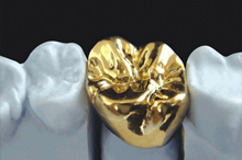 The preparation of a tooth for a gold crown is the simplest and least complicated preparation