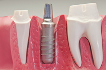 Dental implants are surgically implanted in the jaw to provide a comfortable, secure fit and a natural look