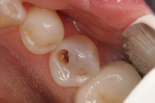 Periodontal disease is the number one cause of tooth loss in the United States today.